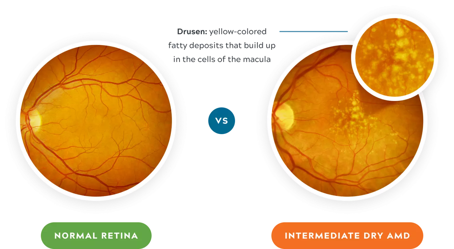 Normal vs intermediate dry amd desktop