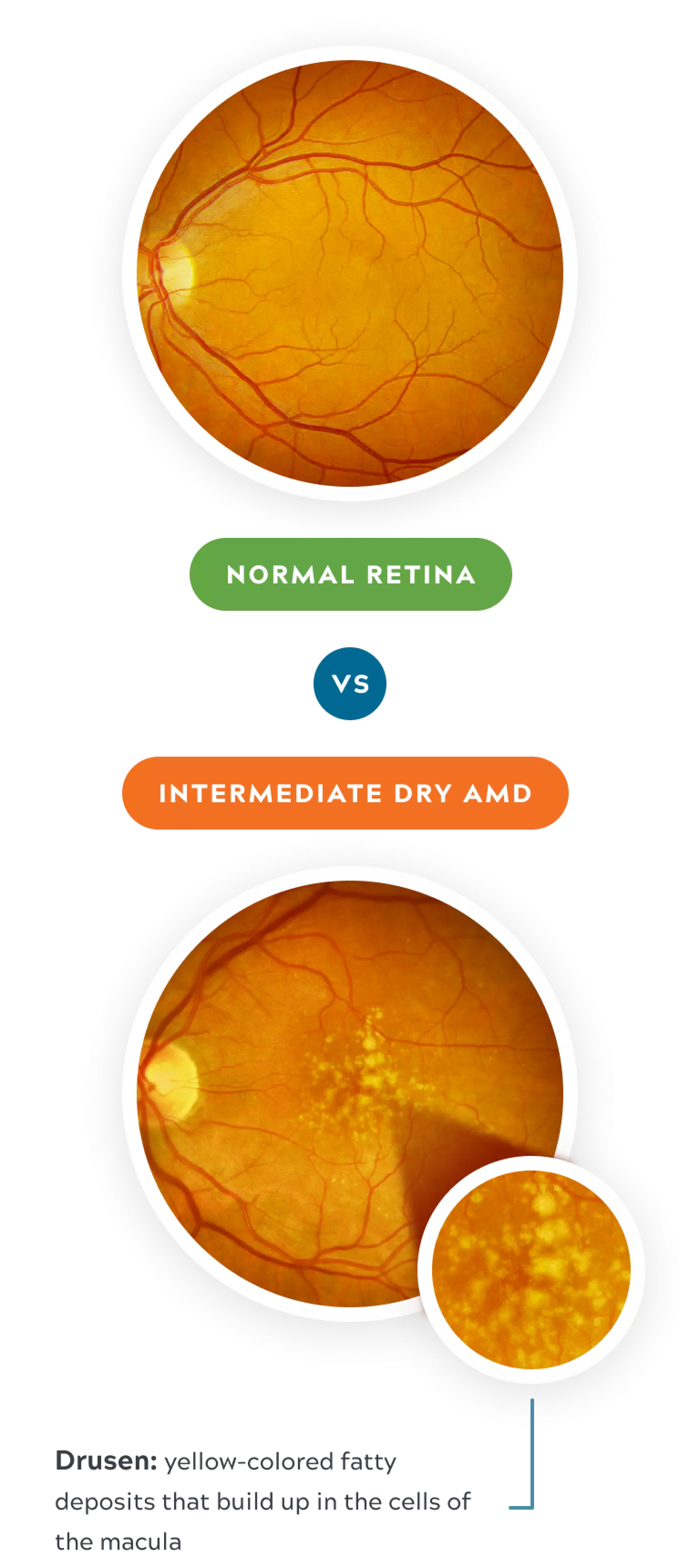 Normal vs intermediate dry amd mobile