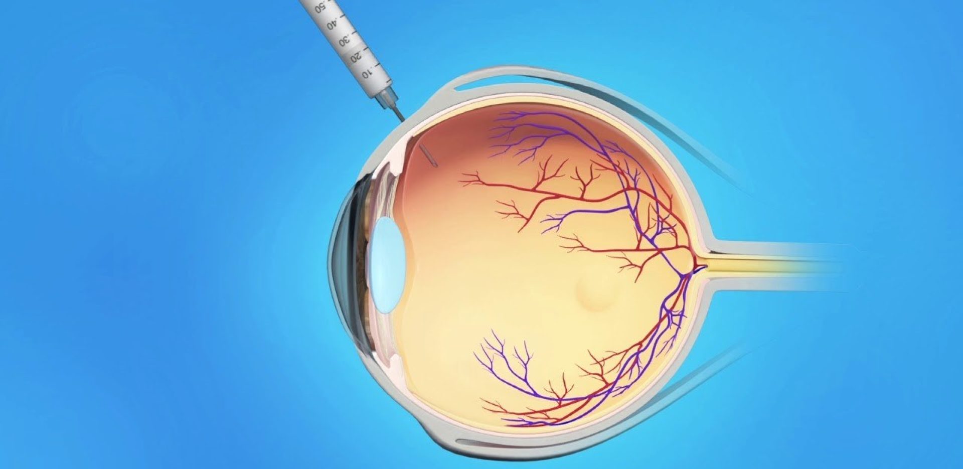 Wet Amd Injections